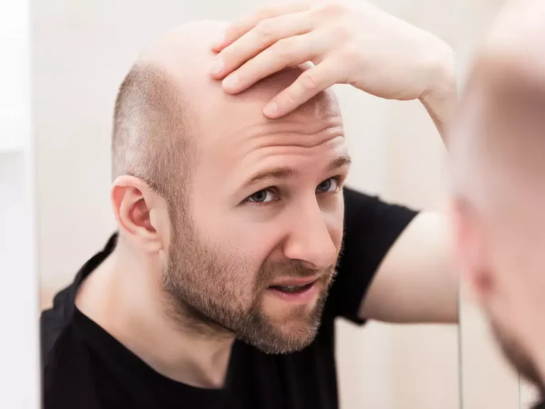 Here Is What You Need to Know About Hair Restoration